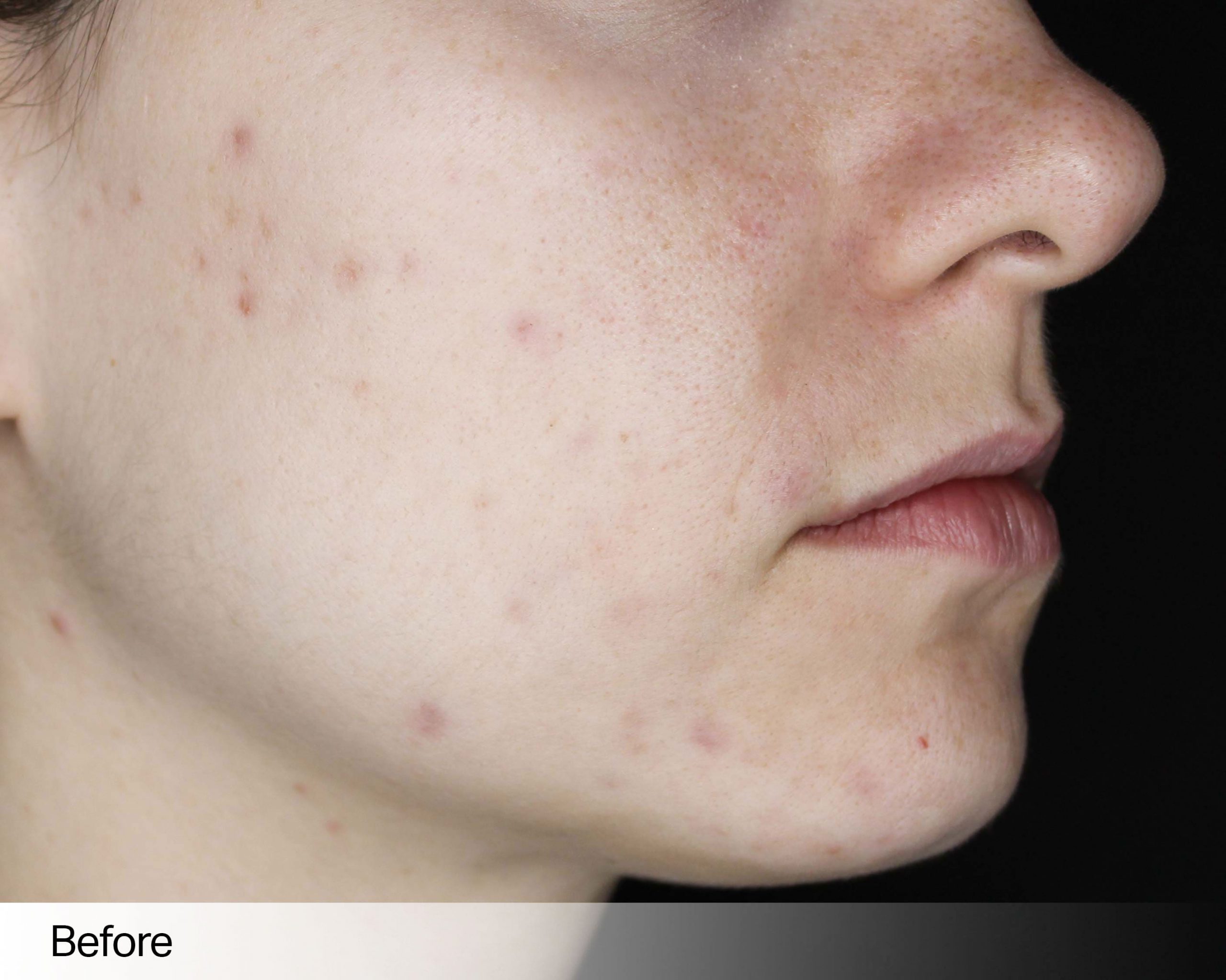 skin-needling-12a-min