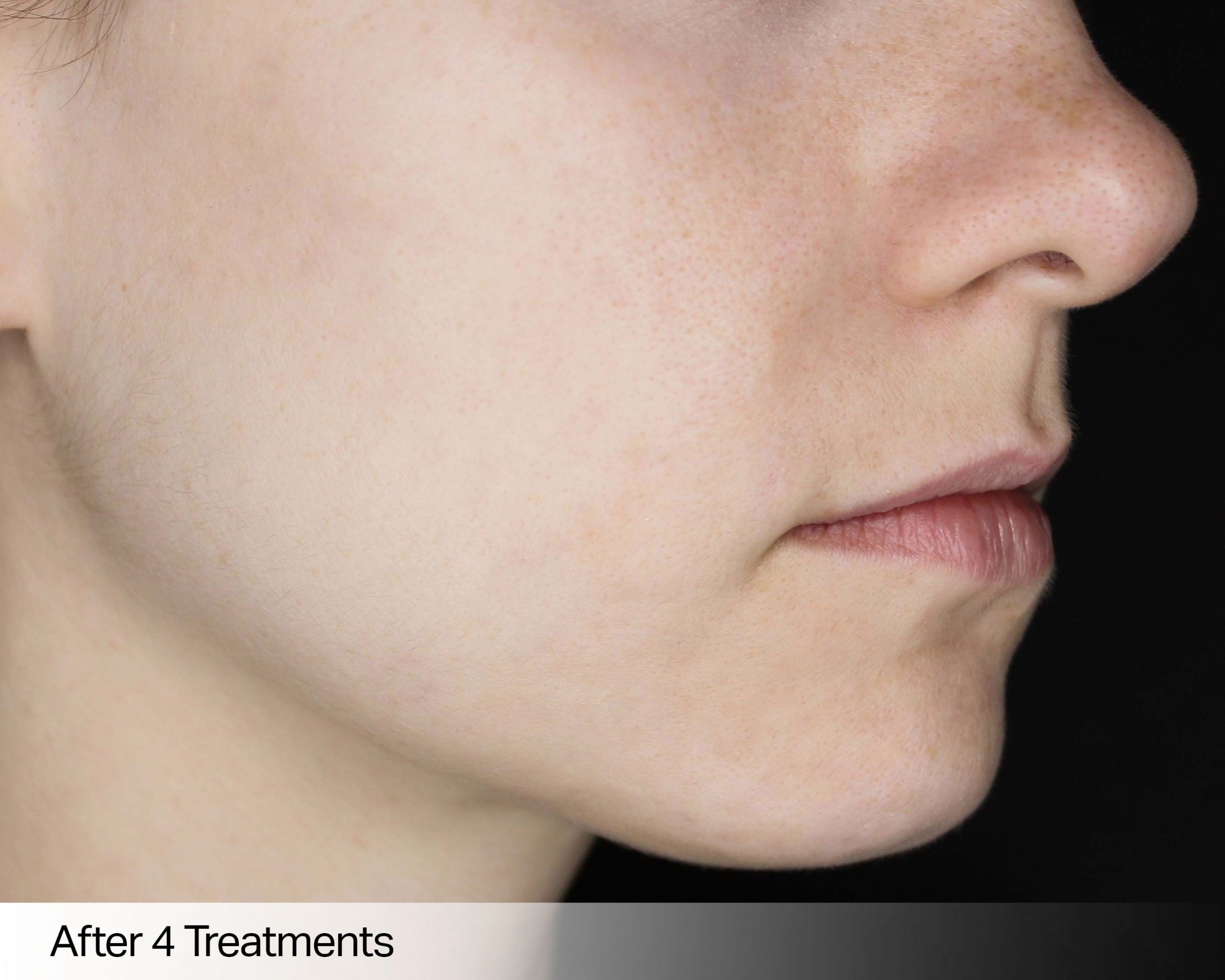 skin-needling-12b-min