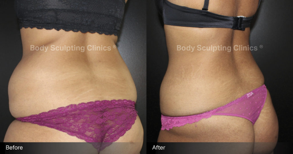 Cryo-female-4 Cryo-female-4