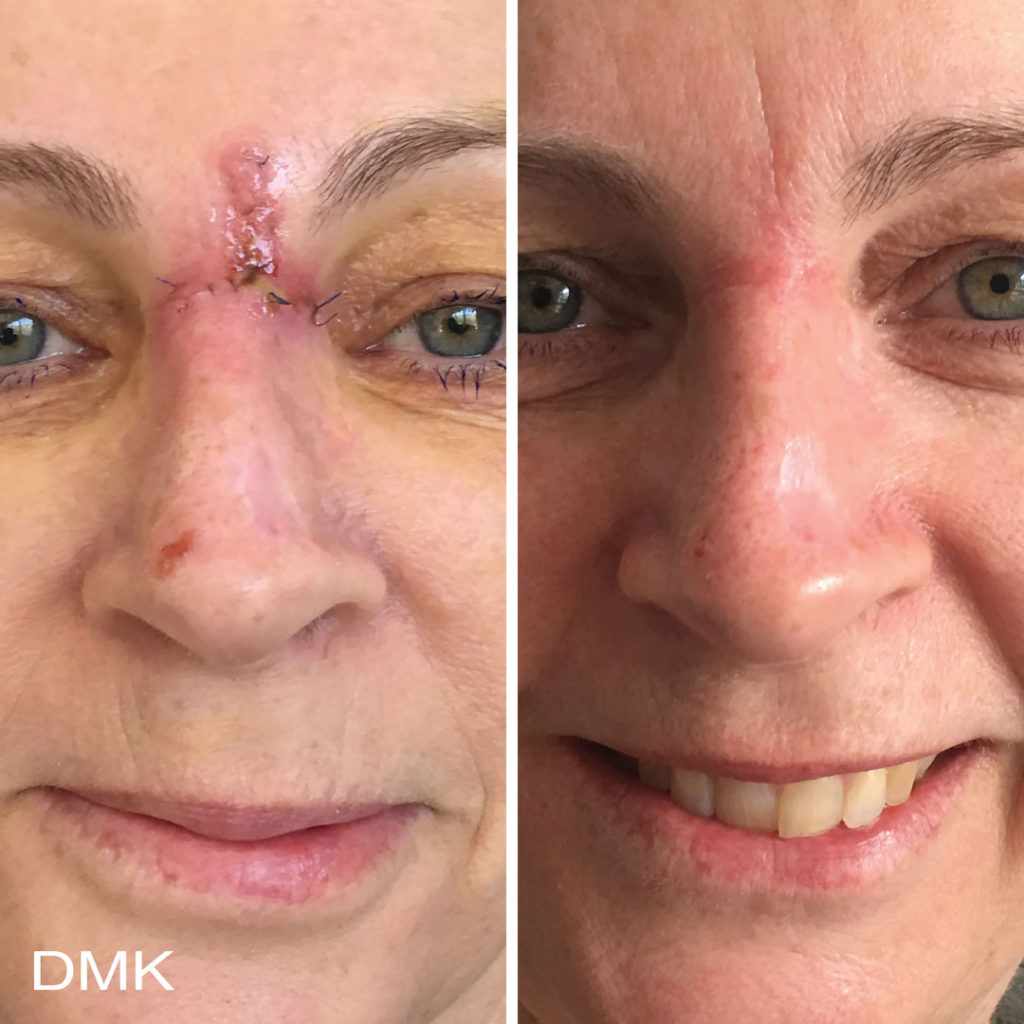 DMK-body-sculpting-clinics-before-after-acne-00001 DMK-body-sculpting-clinics-before-after-acne-00001