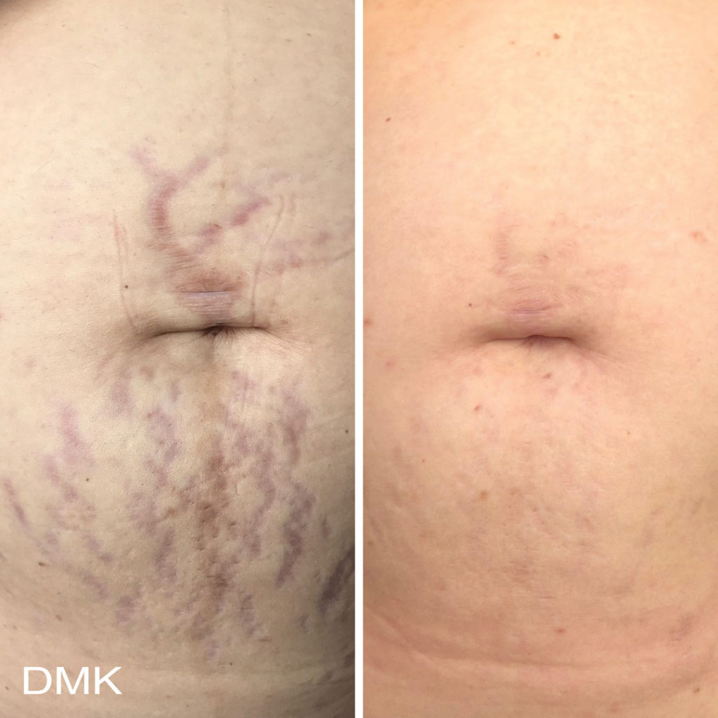 DMK-body-sculpting-clinics-before-after-acne-00002 DMK-body-sculpting-clinics-before-after-acne-00002