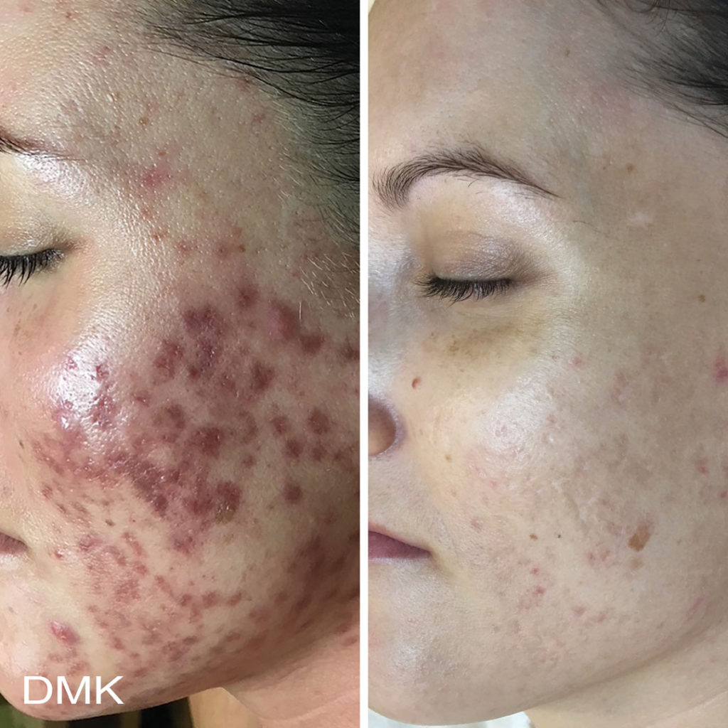DMK-body-sculpting-clinics-before-after-acne-00003 DMK-body-sculpting-clinics-before-after-acne-00003