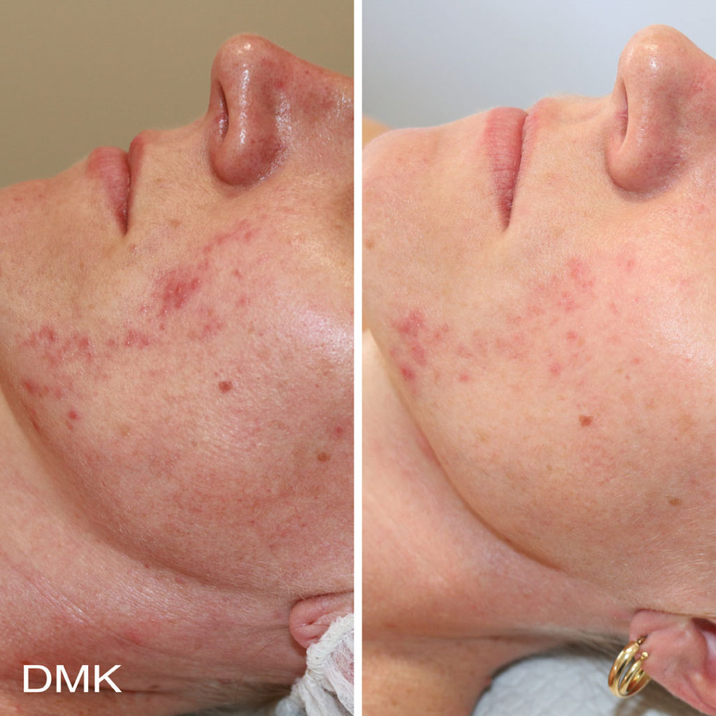 DMK-body-sculpting-clinics-before-after-acne-00008 DMK-body-sculpting-clinics-before-after-acne-00008