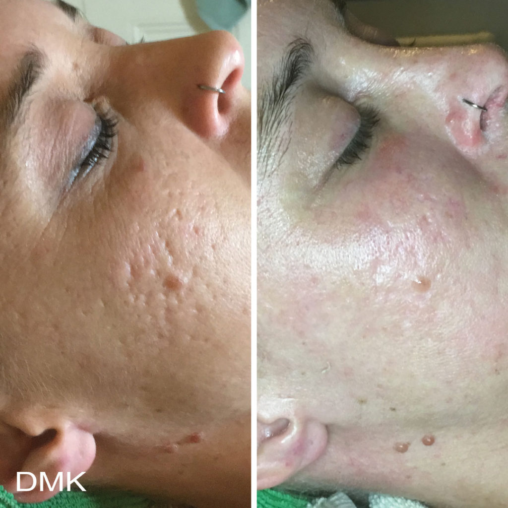 DMK-body-sculpting-clinics-before-after-acne-00011 DMK-body-sculpting-clinics-before-after-acne-00011