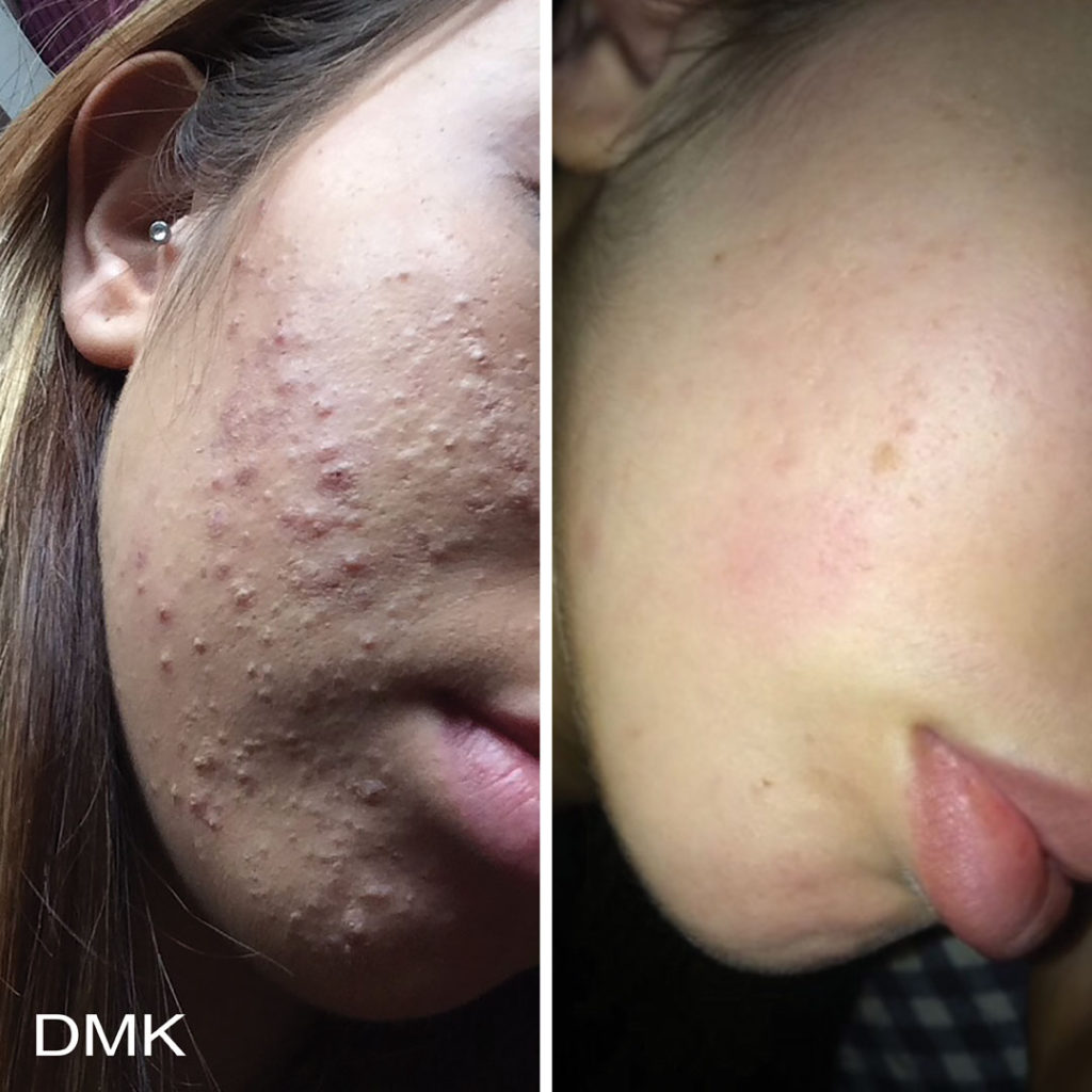 DMK-body-sculpting-clinics-before-after-acne-00014 DMK-body-sculpting-clinics-before-after-acne-00014