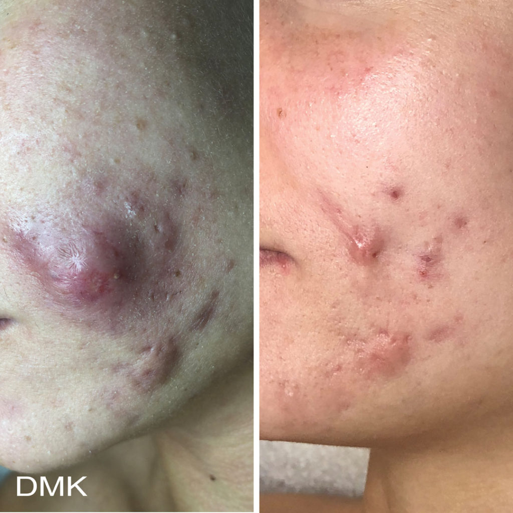 DMK-body-sculpting-clinics-before-after-acne-00015 DMK-body-sculpting-clinics-before-after-acne-00015