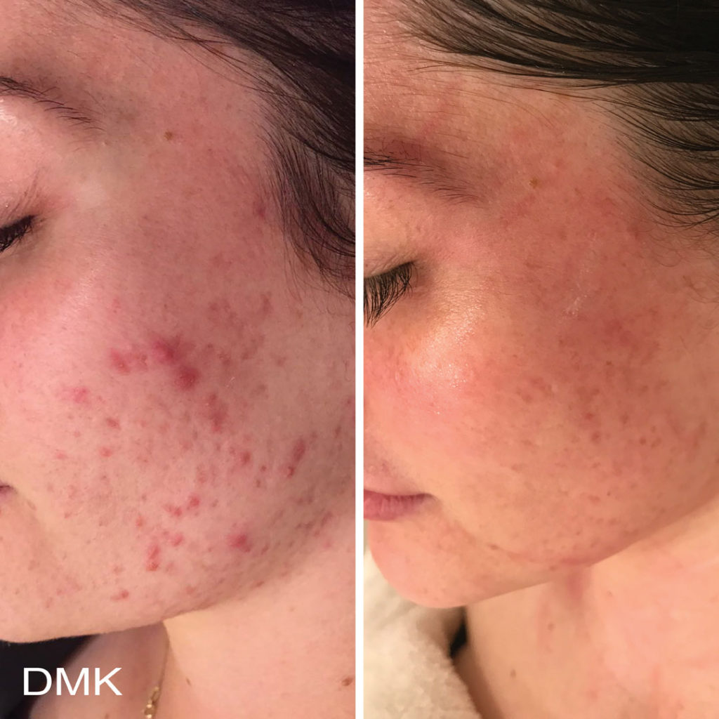 DMK-body-sculpting-clinics-before-after-acne-00016 DMK-body-sculpting-clinics-before-after-acne-00016