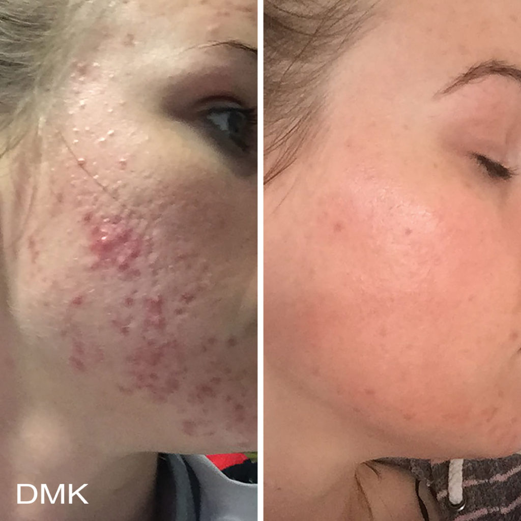 DMK-body-sculpting-clinics-before-after-acne-00017 DMK-body-sculpting-clinics-before-after-acne-00017