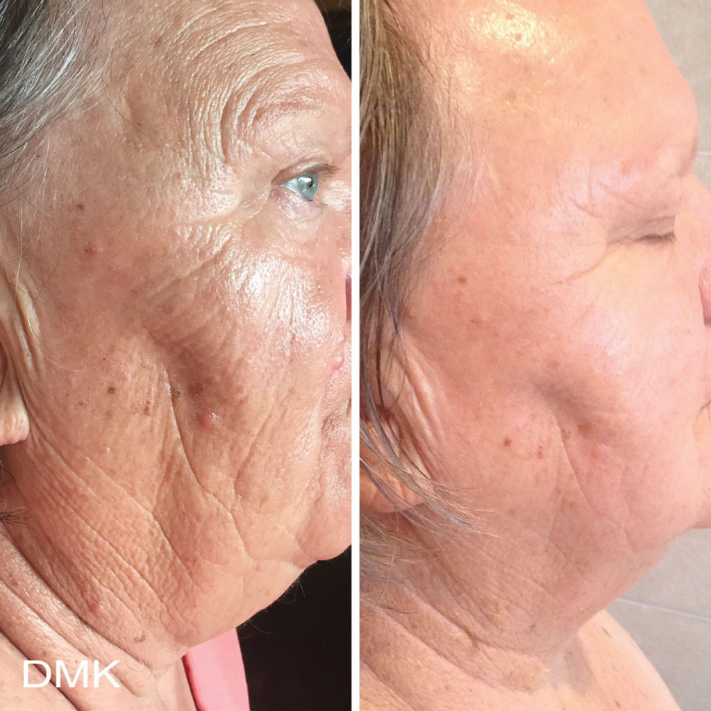 DMK-body-sculpting-clinics-before-after-aging-00002 DMK-body-sculpting-clinics-before-after-aging-00002