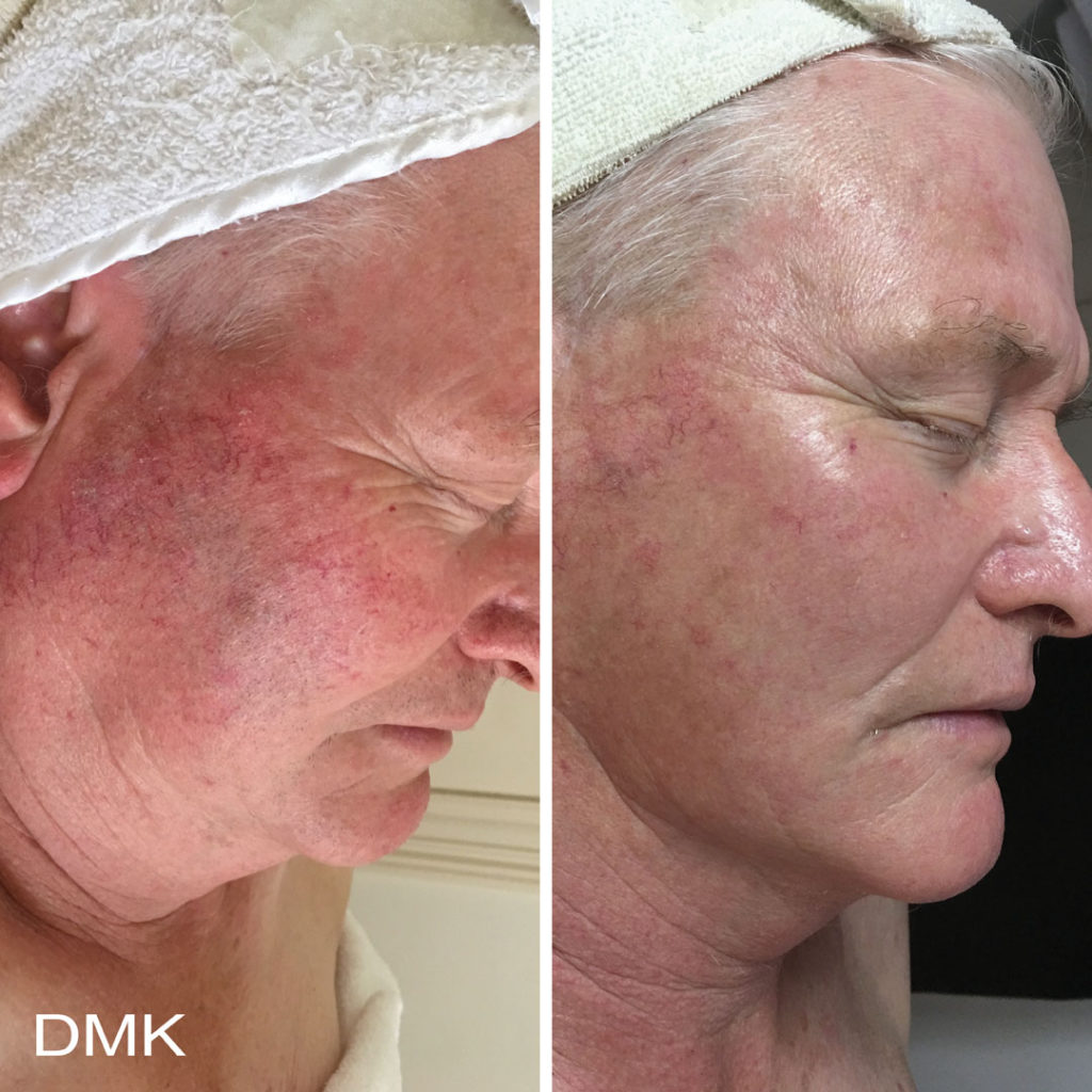 DMK-body-sculpting-clinics-before-after-aging-00004 DMK-body-sculpting-clinics-before-after-aging-00004