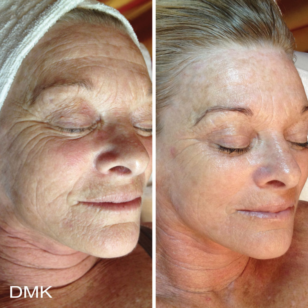 DMK-body-sculpting-clinics-before-after-aging-00005 DMK-body-sculpting-clinics-before-after-aging-00005