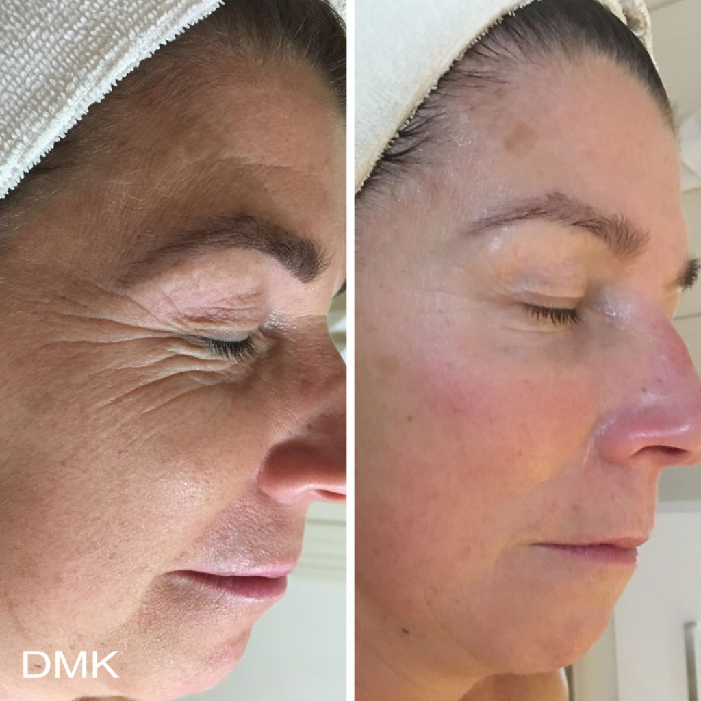 DMK-body-sculpting-clinics-before-after-aging-00006 DMK-body-sculpting-clinics-before-after-aging-00006