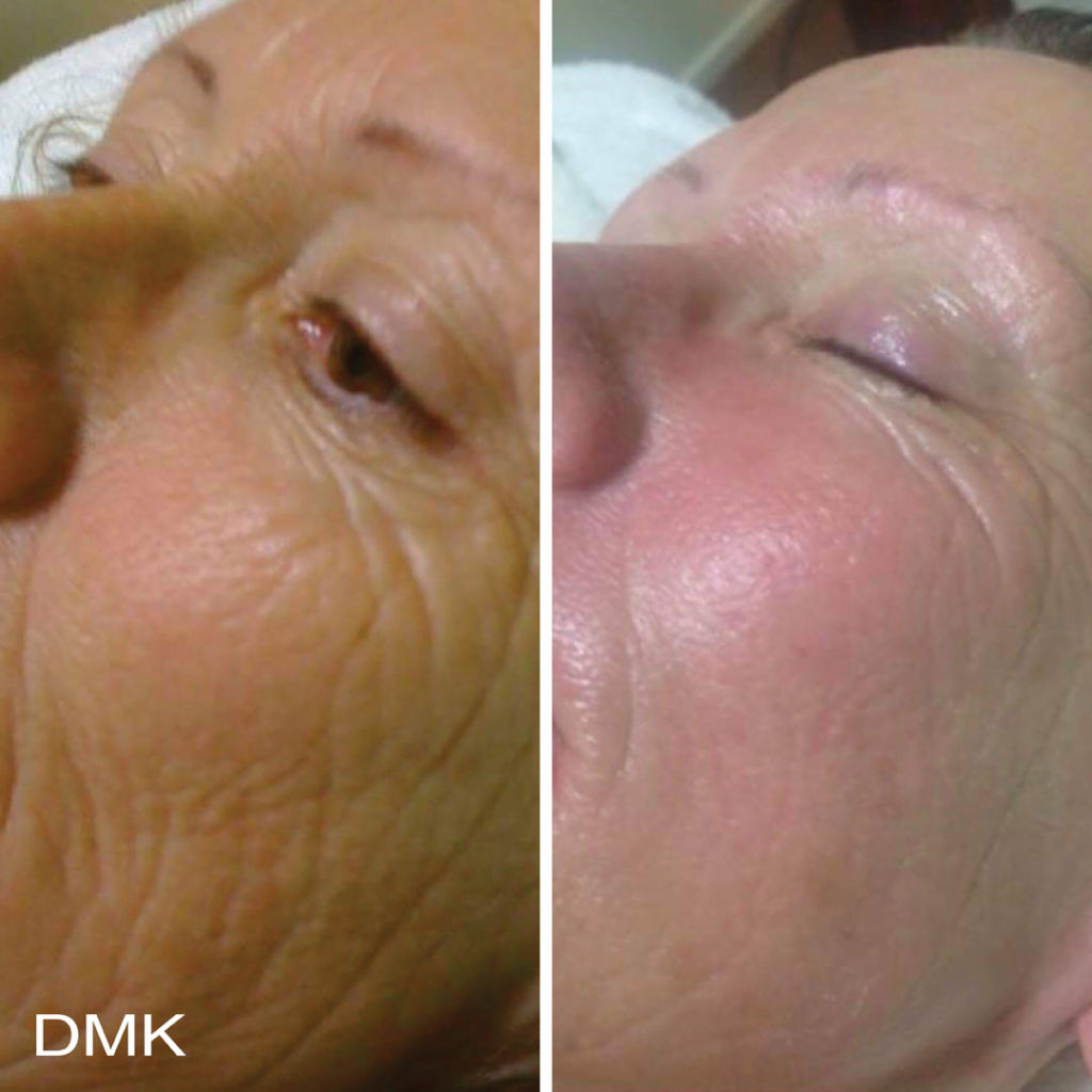 DMK-body-sculpting-clinics-before-after-aging-00007 DMK-body-sculpting-clinics-before-after-aging-00007