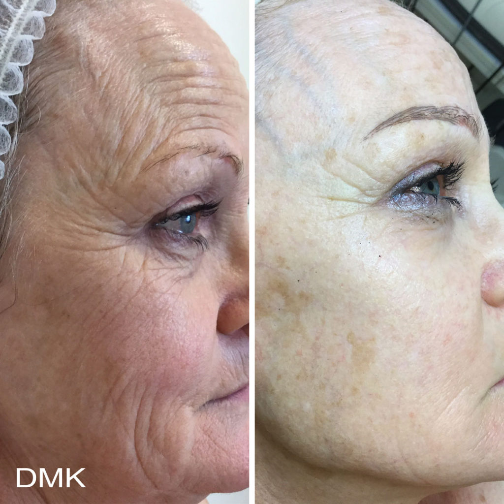DMK-body-sculpting-clinics-before-after-aging-00008 DMK-body-sculpting-clinics-before-after-aging-00008