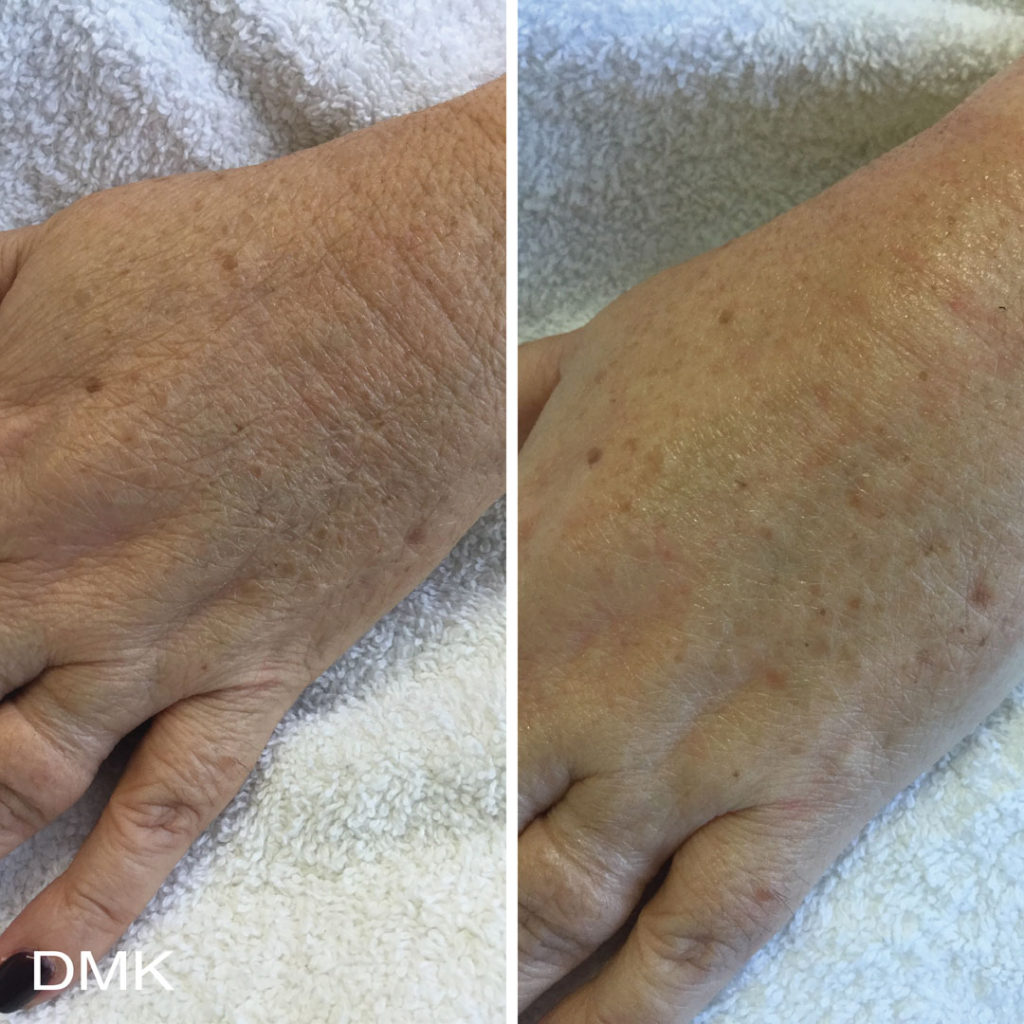 DMK-body-sculpting-clinics-before-after-aging-00009 DMK-body-sculpting-clinics-before-after-aging-00009