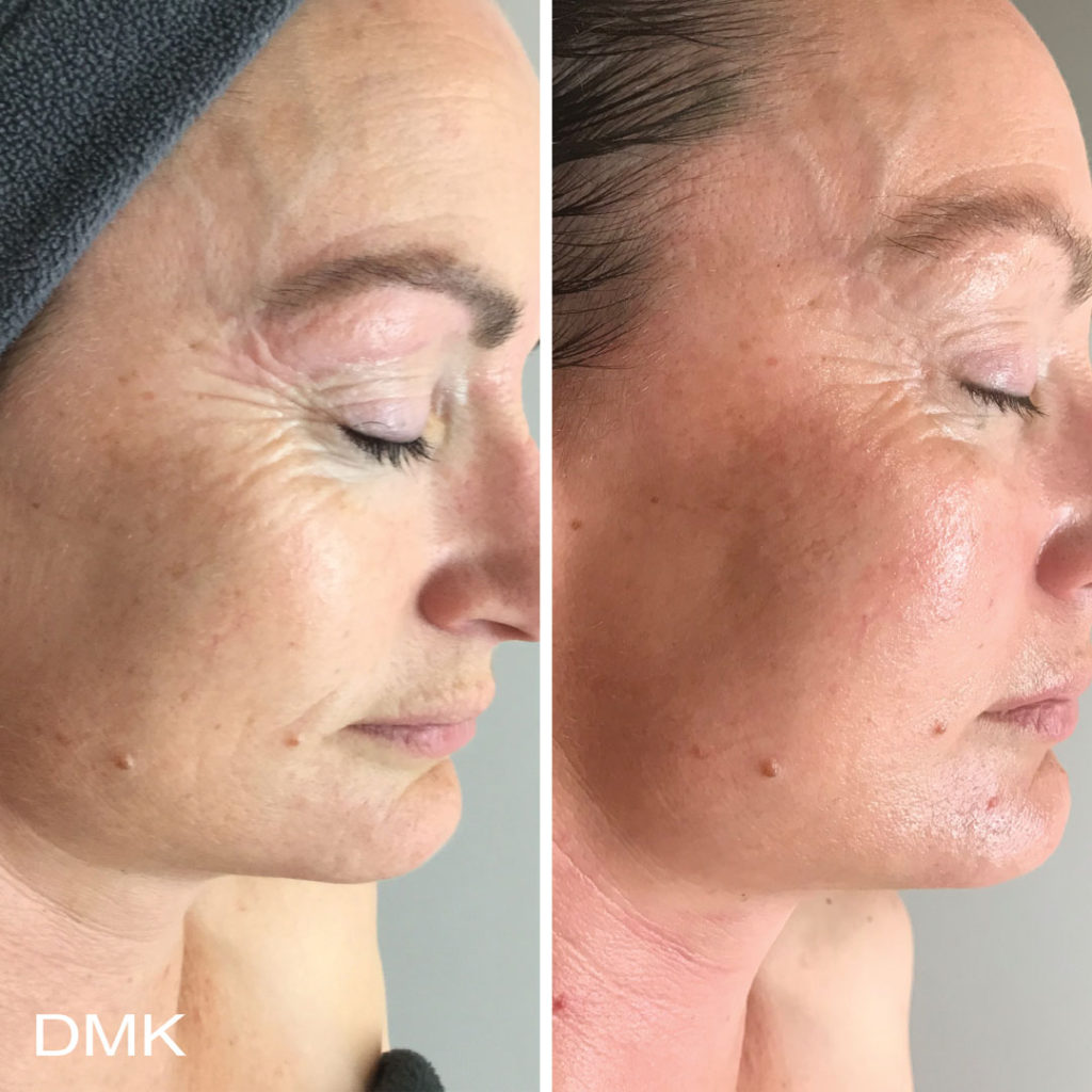 DMK-body-sculpting-clinics-before-after-aging-00010 DMK-body-sculpting-clinics-before-after-aging-00010