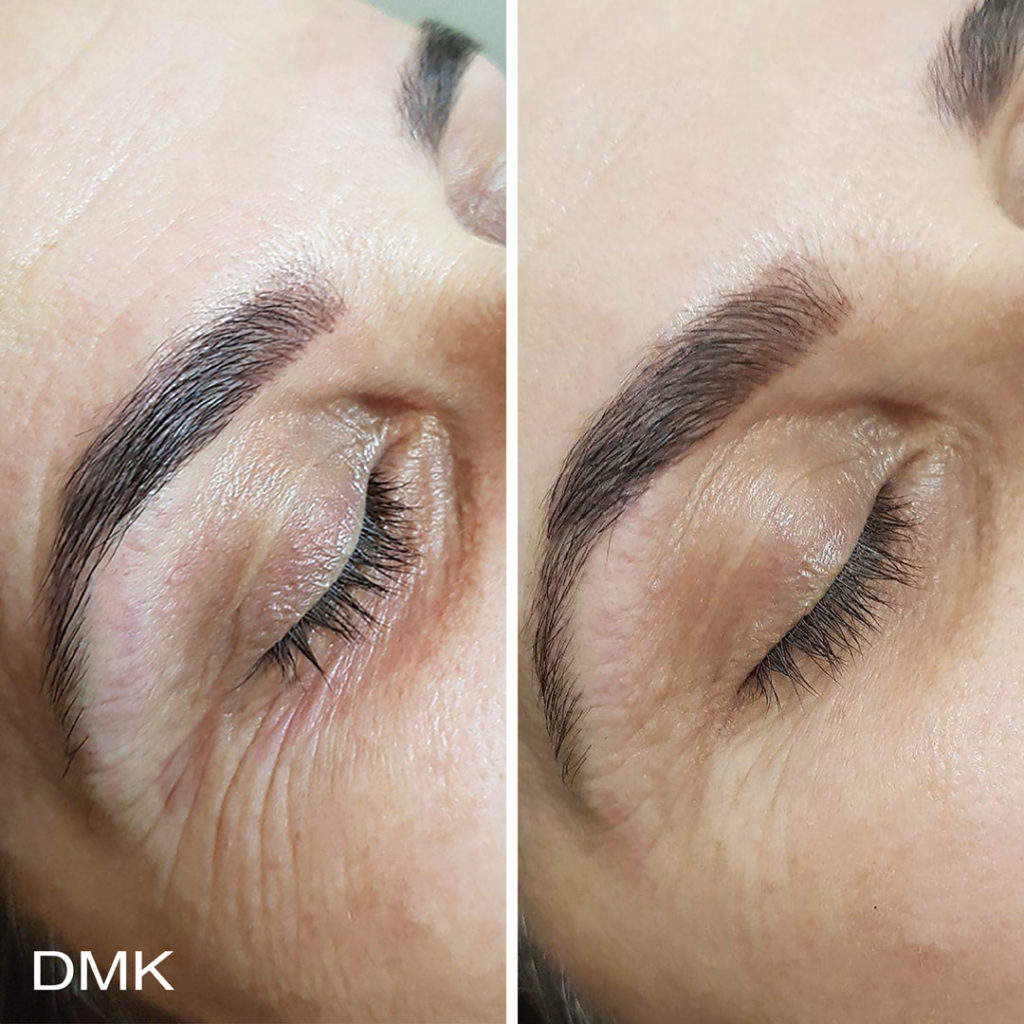 DMK-body-sculpting-clinics-before-after-aging-00012 DMK-body-sculpting-clinics-before-after-aging-00012
