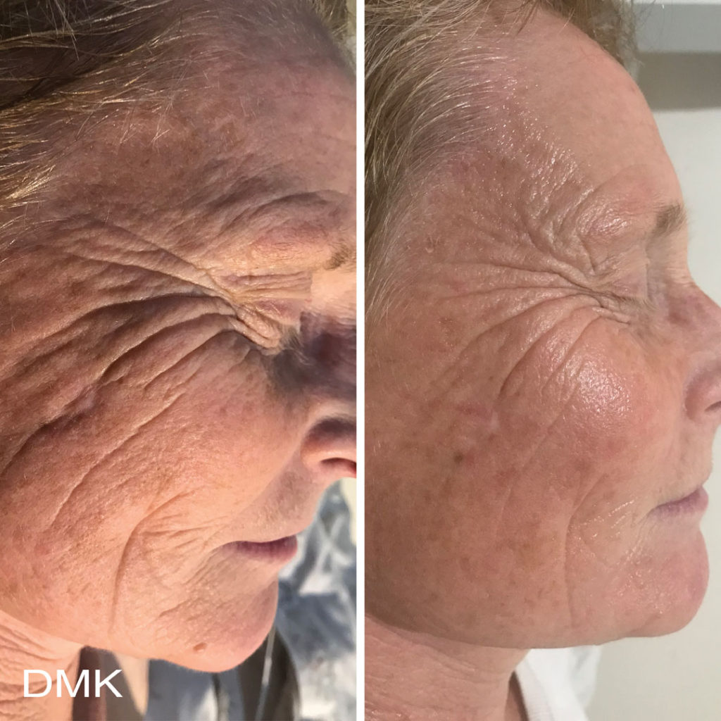 DMK-body-sculpting-clinics-before-after-aging-00013 DMK-body-sculpting-clinics-before-after-aging-00013