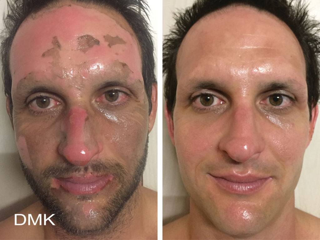 DMK-body-sculpting-clinics-before-after-betagel-00003 DMK-body-sculpting-clinics-before-after-betagel-00003