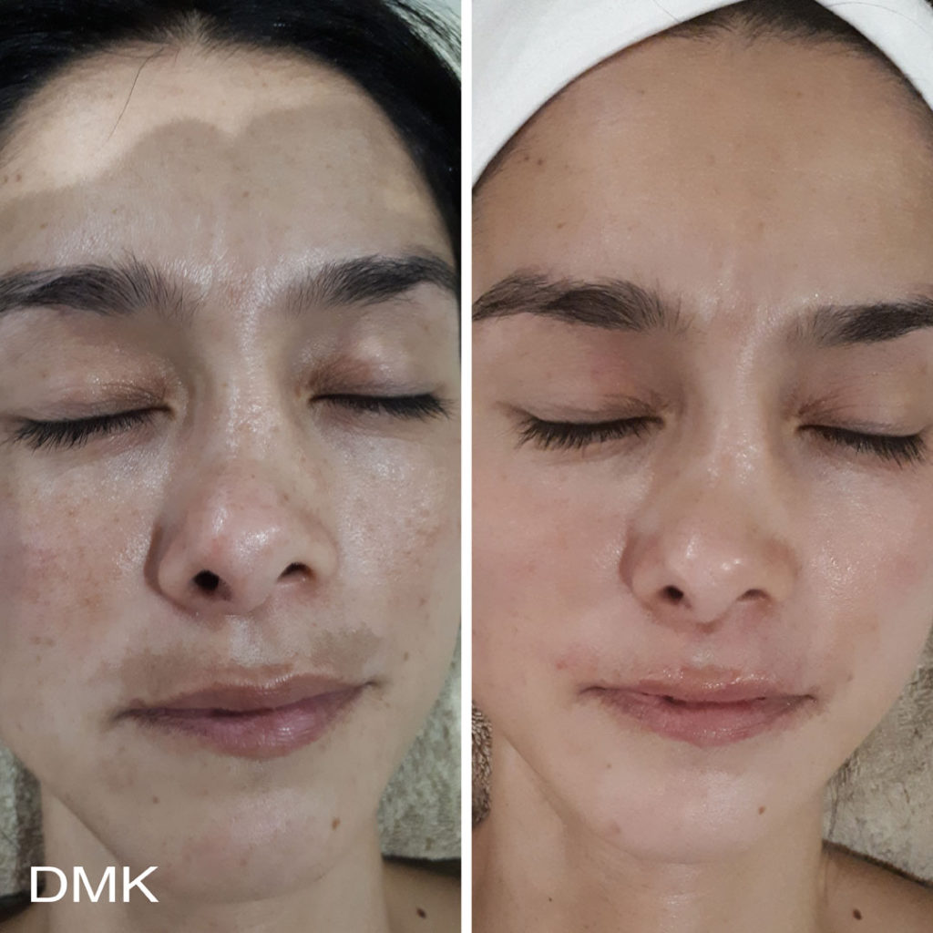 DMK-body-sculpting-clinics-before-after-pigmentation-00001 DMK-body-sculpting-clinics-before-after-pigmentation-00001