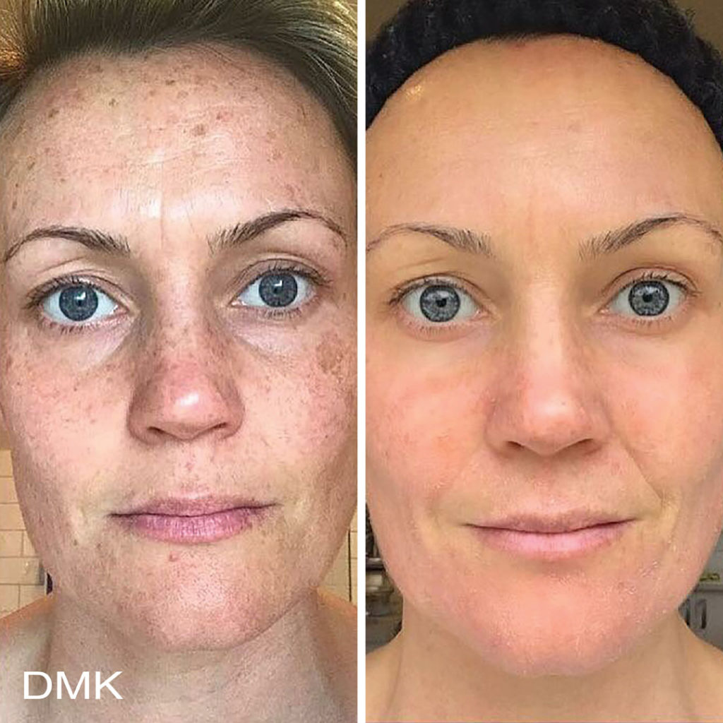 DMK-body-sculpting-clinics-before-after-pigmentation-00002 DMK-body-sculpting-clinics-before-after-pigmentation-00002