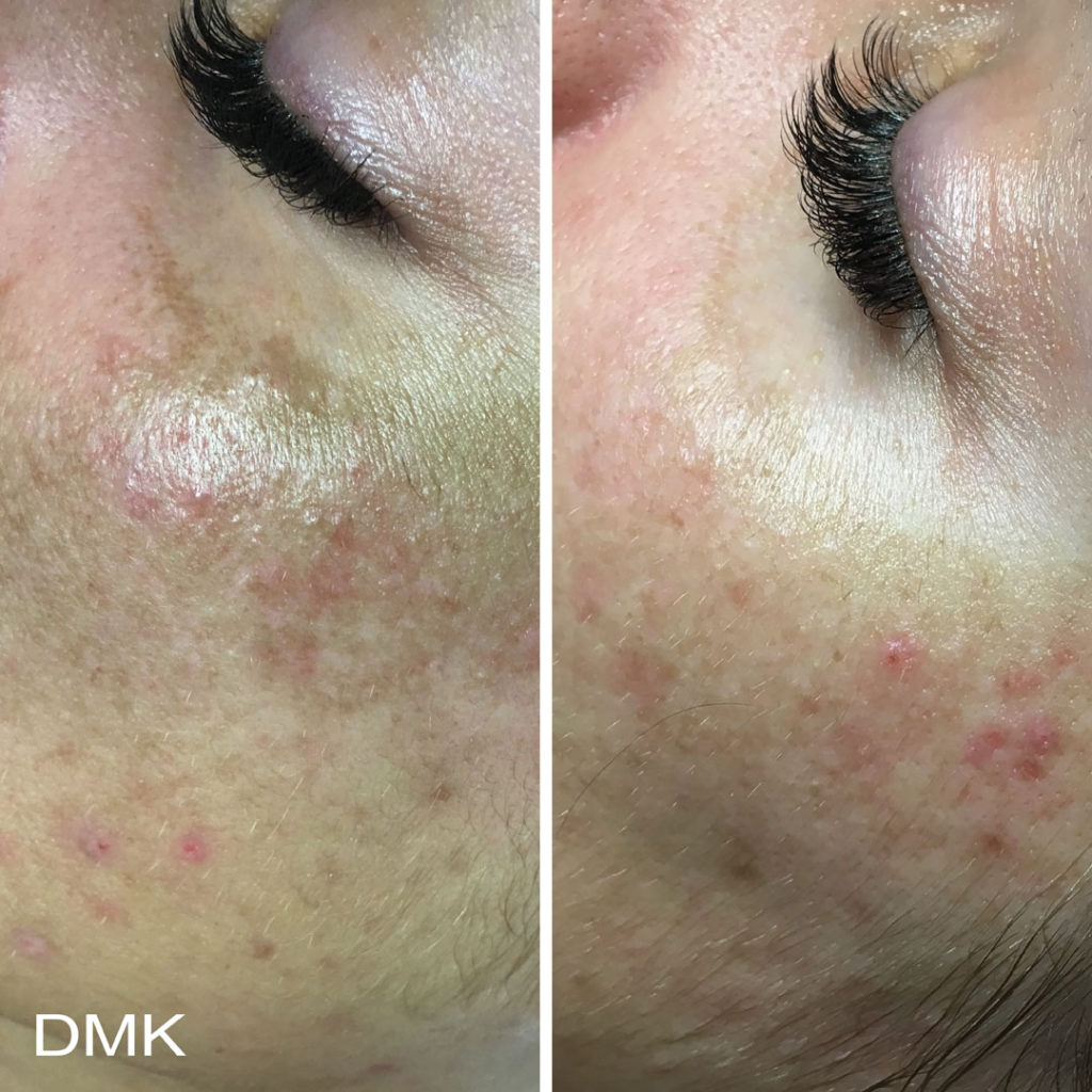 DMK-body-sculpting-clinics-before-after-pigmentation-00003 DMK-body-sculpting-clinics-before-after-pigmentation-00003