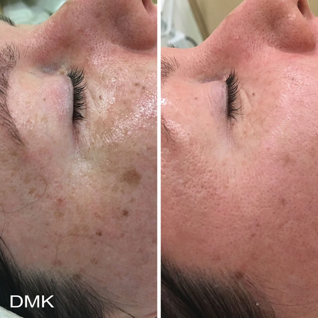 DMK-body-sculpting-clinics-before-after-pigmentation-00004 DMK-body-sculpting-clinics-before-after-pigmentation-00004