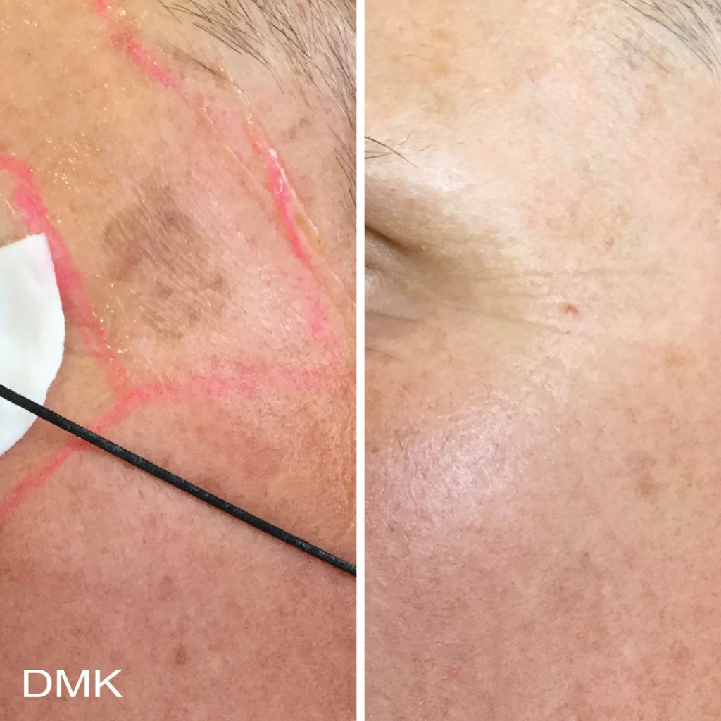 DMK-body-sculpting-clinics-before-after-pigmentation-00005 DMK-body-sculpting-clinics-before-after-pigmentation-00005