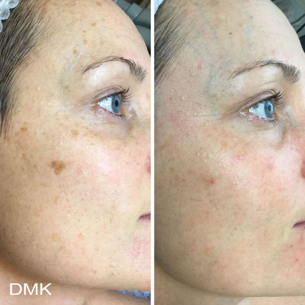 DMK-body-sculpting-clinics-before-after-pigmentation-00006 DMK-body-sculpting-clinics-before-after-pigmentation-00006