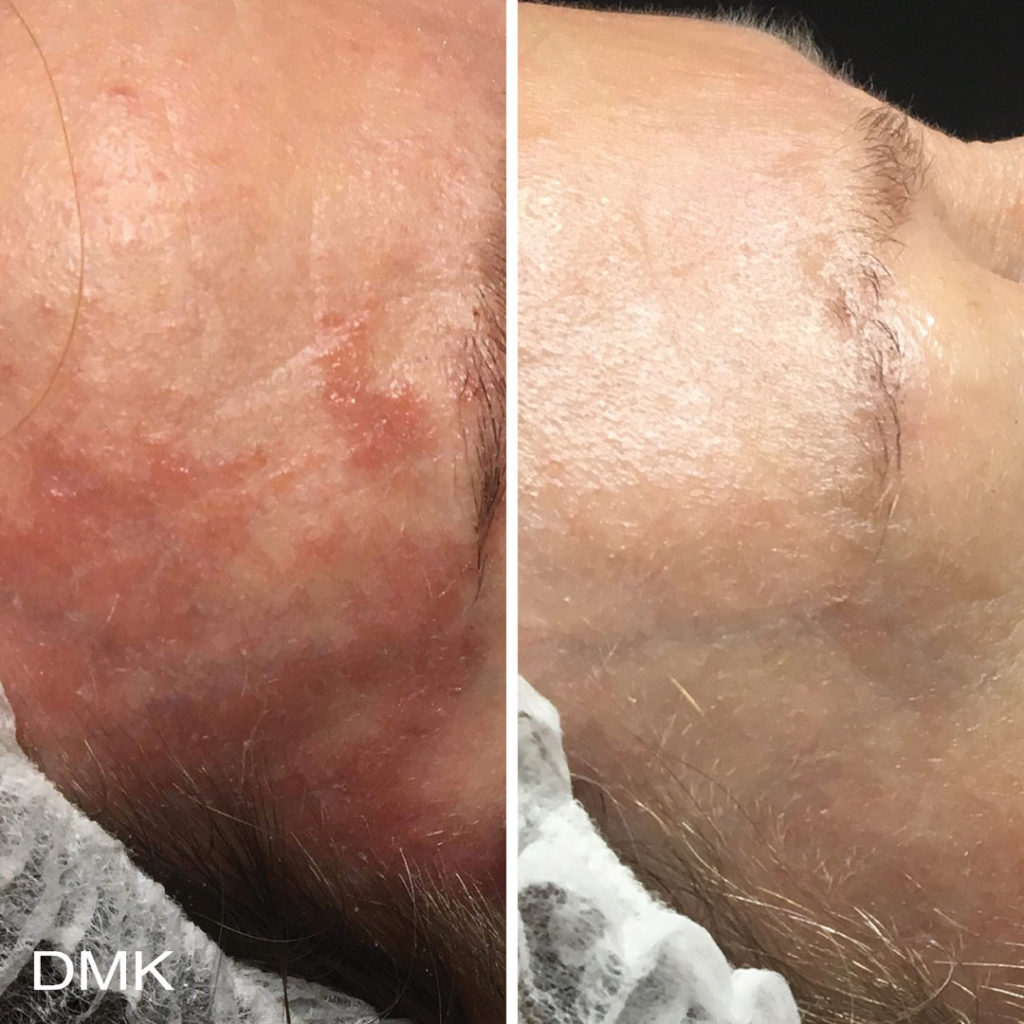DMK-body-sculpting-clinics-before-after-reactive-skin-00001 DMK-body-sculpting-clinics-before-after-reactive-skin-00001