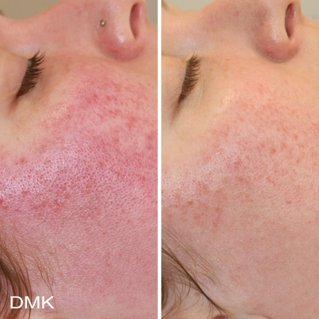 DMK-body-sculpting-clinics-before-after-reactive-skin-00003 DMK-body-sculpting-clinics-before-after-reactive-skin-00003