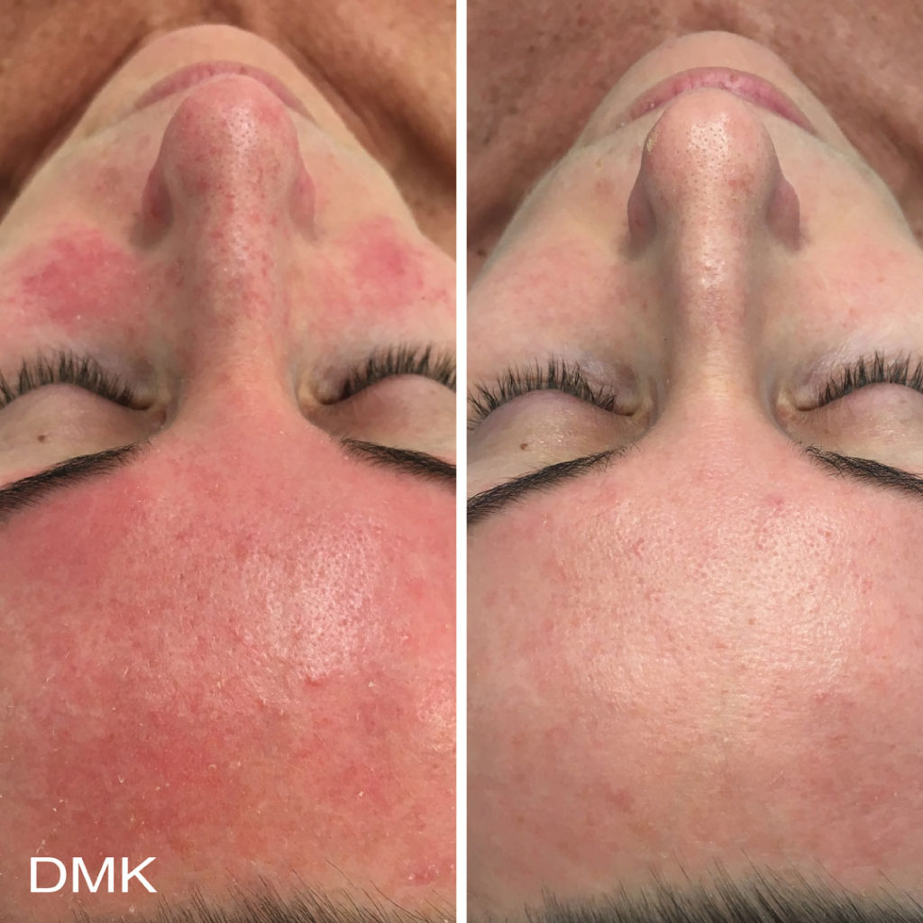 DMK-body-sculpting-clinics-before-after-reactive-skin-00004 DMK-body-sculpting-clinics-before-after-reactive-skin-00004