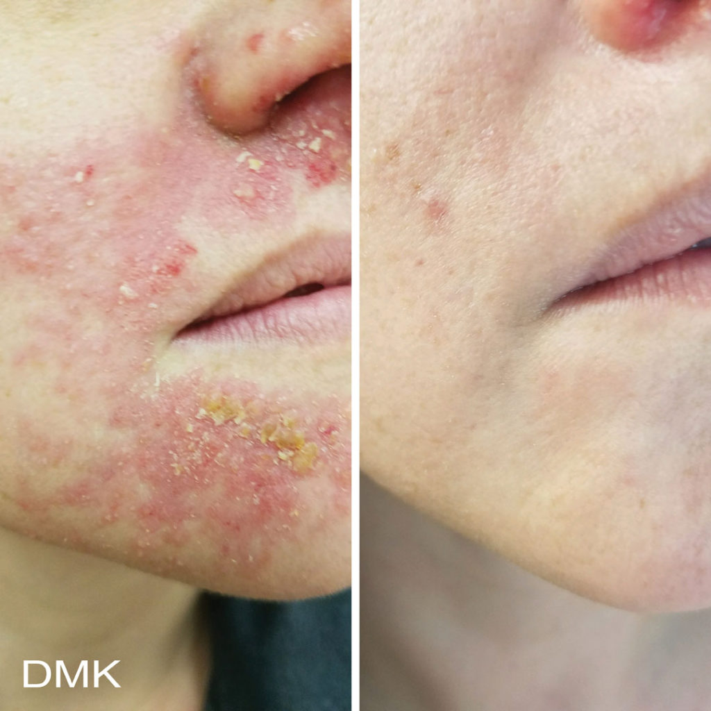 DMK-body-sculpting-clinics-before-after-reactive-skin-00005 DMK-body-sculpting-clinics-before-after-reactive-skin-00005