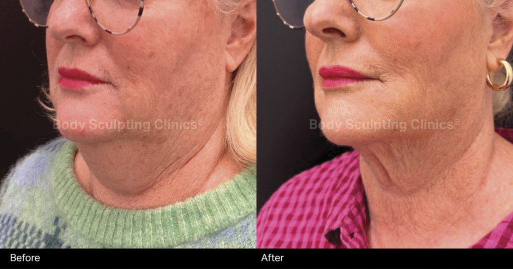 hifu-lower-face-B+A-3 hifu-lower-face-B+A-3