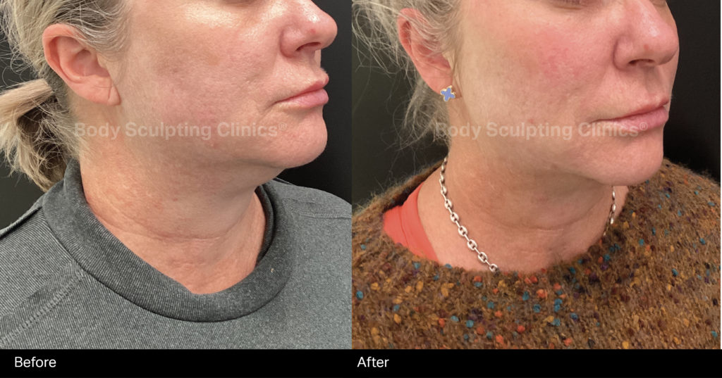 hifu-lower-face-female-B+A-1 hifu-lower-face-female-B+A-1