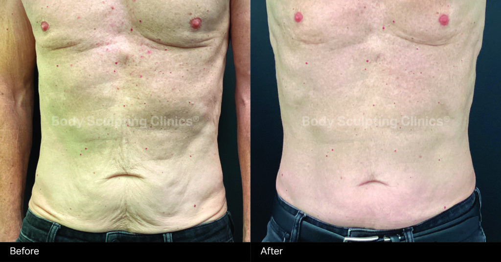 hifu-body-Before+After-1 hifu-body-Before+After-1