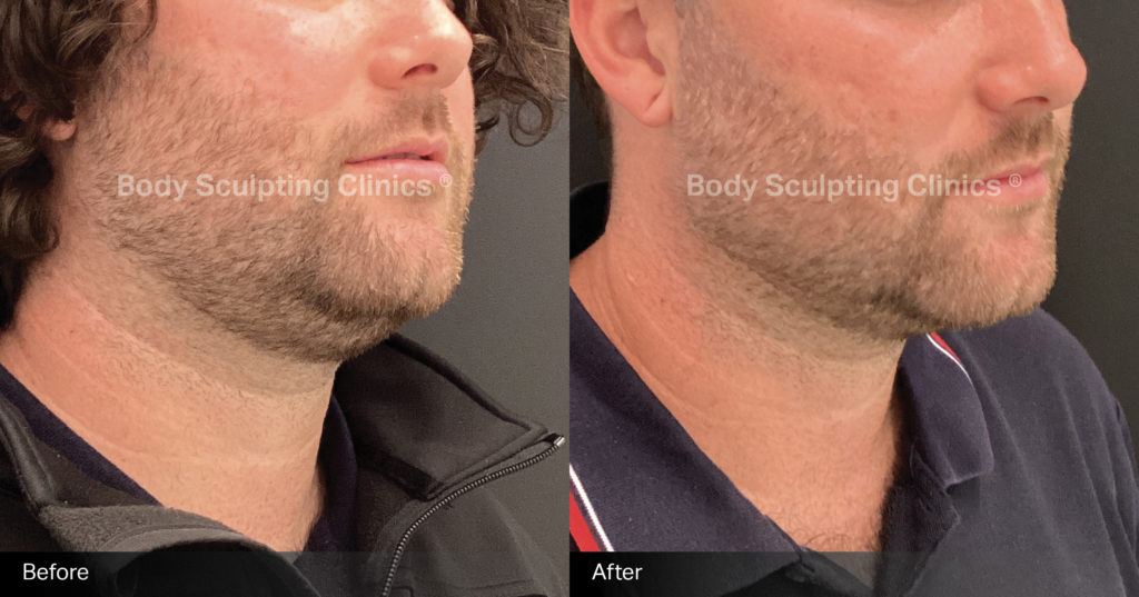 Cryo-chin-male-1 Cryo-chin-male-1