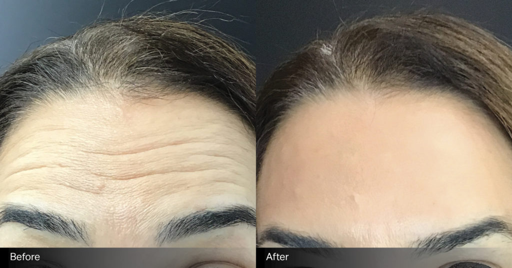 anti-wrinkle-B+A-1 anti-wrinkle-B+A-1