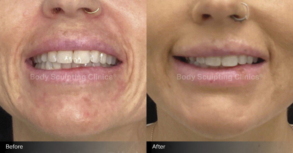 anti-wrinkle-B+A-3 anti-wrinkle-B+A-3