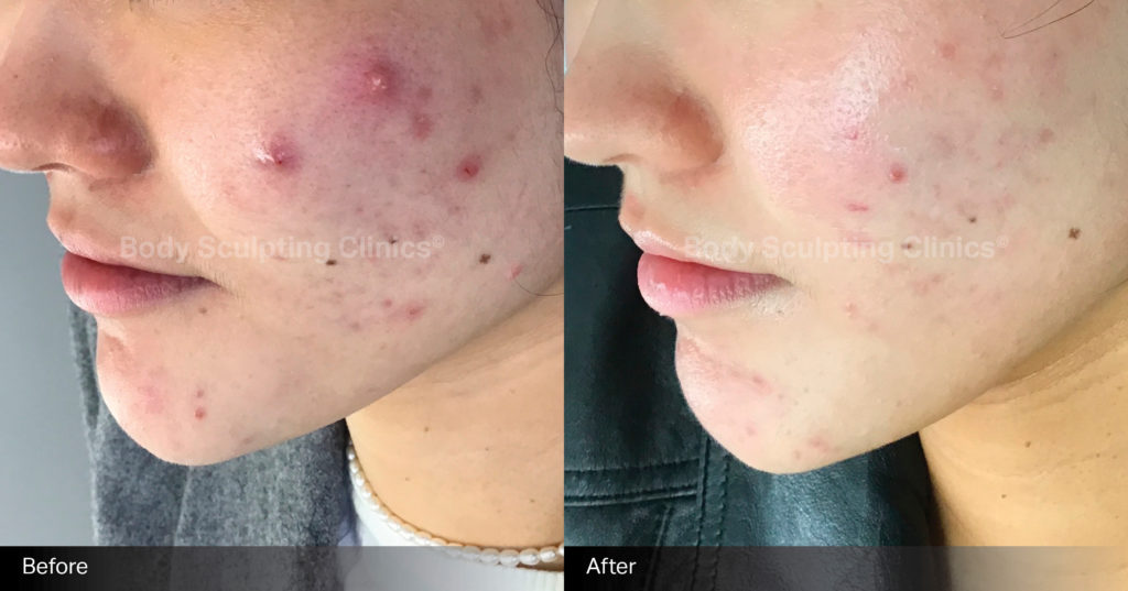 body-sculpting-clinics-skin-led-peels-1 body-sculpting-clinics-skin-led-peels-1