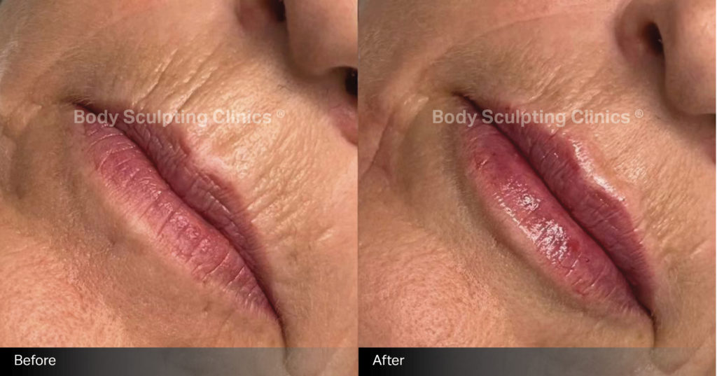 lips-dermal-filler-Female-1 lips-dermal-filler-Female-1