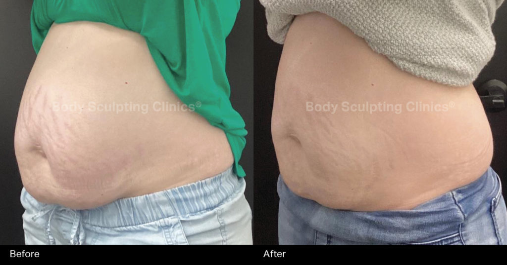 permanent-fat-reduction-abs-11 permanent-fat-reduction-abs-11
