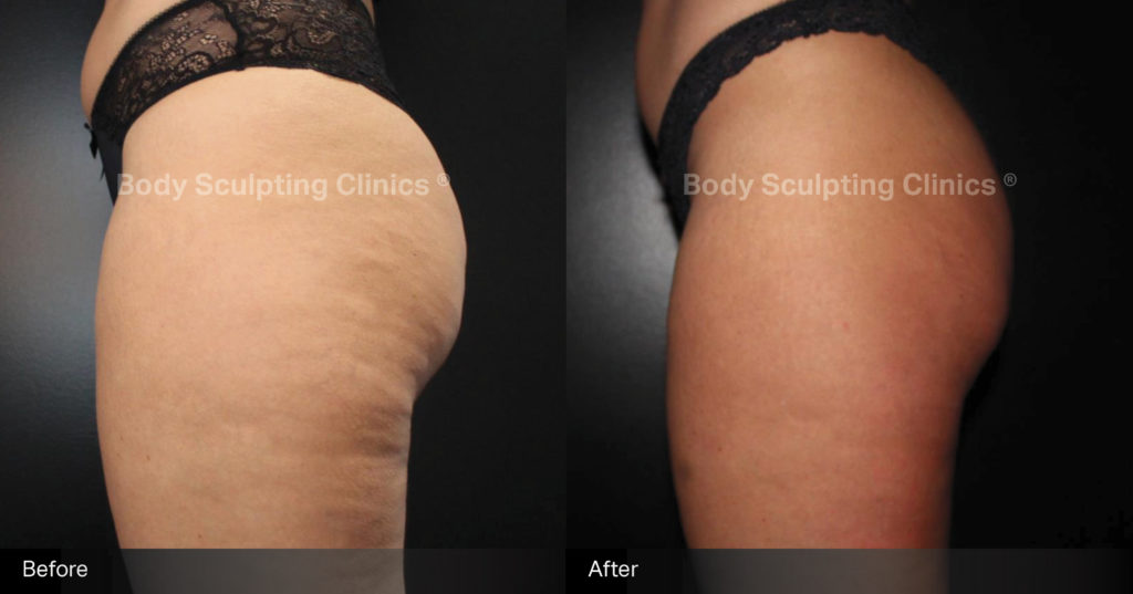 sculptra-cellulite-Female-1 sculptra-cellulite-Female-1