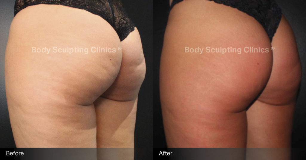 sculptra-cellulite-treatment-before-after-4 sculptra-cellulite-treatment-before-after-4