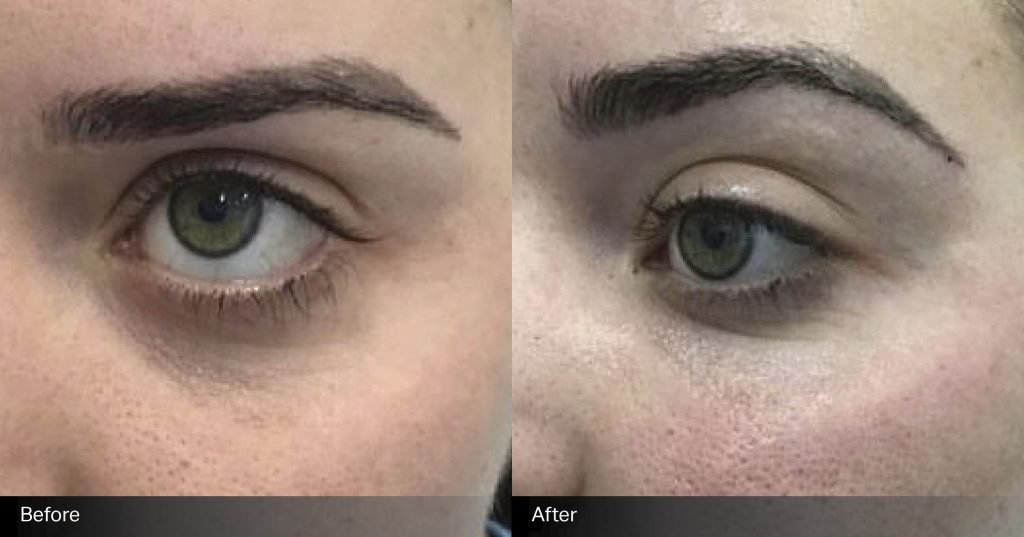 body-sculpting-clinics-sydney-under-eye-filler-before-after-003 body-sculpting-clinics-sydney-under-eye-filler-before-after-003