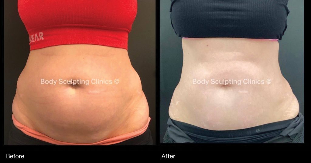 fat-freezing-before-after-body-sculpting-clinics-sydney-Cryo-Female-2024-2 Transform your abdomen with Body Sculpting Clinics Sydney’s TGA registered fat freezing treatment. Non-surgical, precise, and effective body contouring for a beautifully sculpted silhouette.