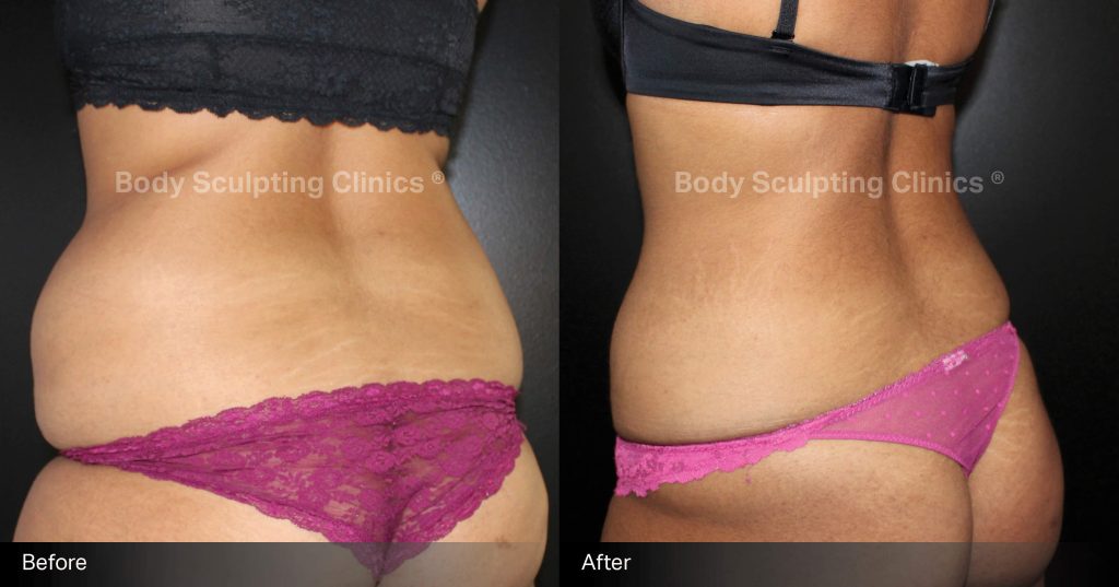 fat-freezing-before-after-body-sculpting-clinics-sydney-Cryo-female-4 Transform your abdomen with Body Sculpting Clinics Sydney’s TGA registered fat freezing treatment. Non-surgical, precise, and effective body contouring for a beautifully sculpted silhouette.