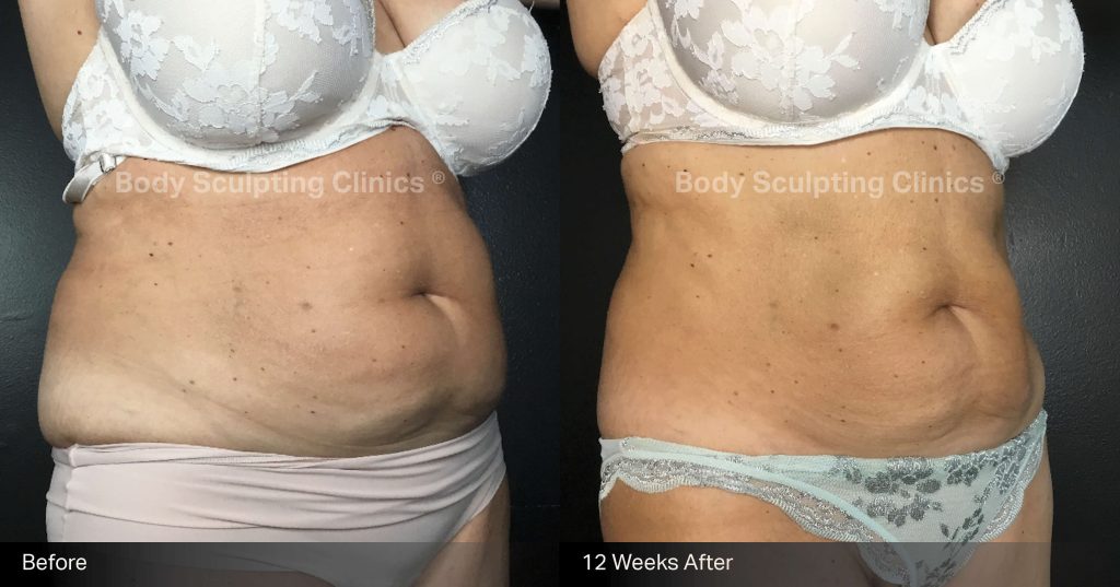 fat-freezing-before-after-body-sculpting-clinics-sydney-abdomen-00006 fat-freezing-before-after-body-sculpting-clinics-sydney-abdomen-00006