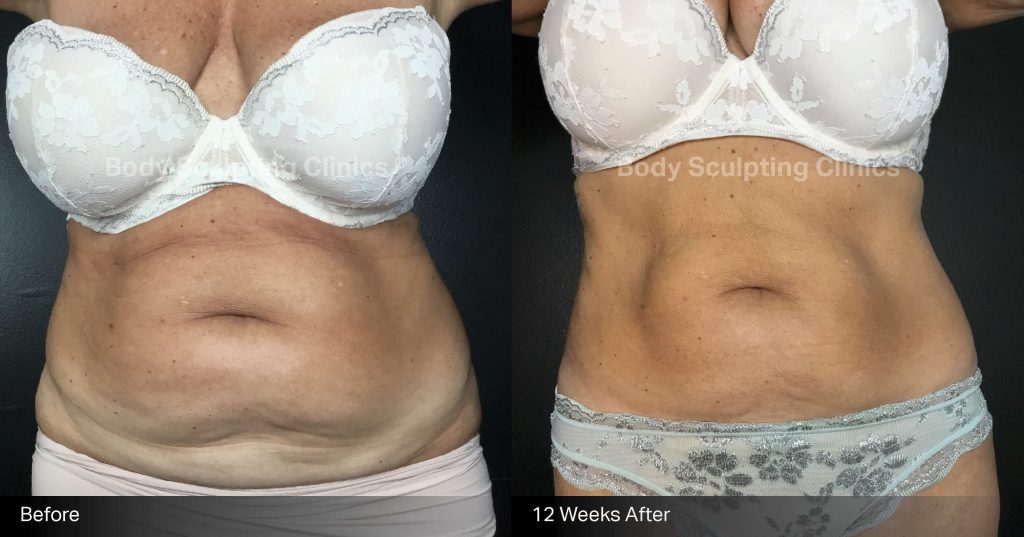 fat-freezing-before-after-body-sculpting-clinics-sydney-abdomen-00011 Before and after fat freezing treatment on female abdomen at Body Sculpting Clinics Sydney — TGA-approved, non-invasive fat reduction with visible body contouring results.