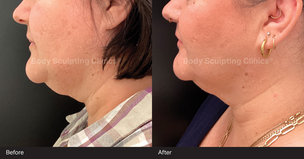 HIFU-body-sculpting-clinics-before-after-treatment-002 Before and after HIFU skin tightening results at Body Sculpting Clinics Sydney